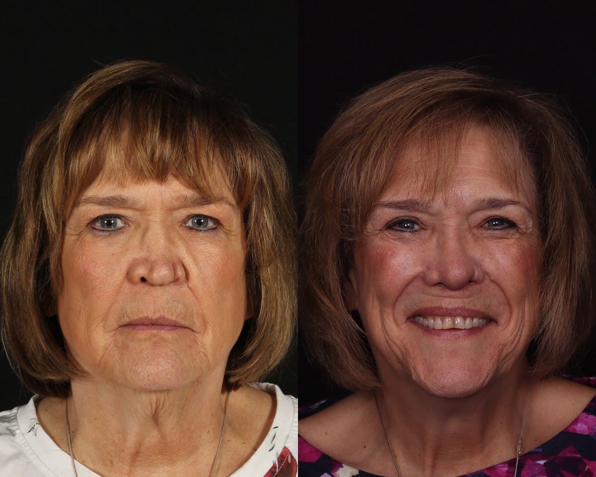 Rhinoplasty Revision Before & After Gallery - Patient 191320 - Image 3