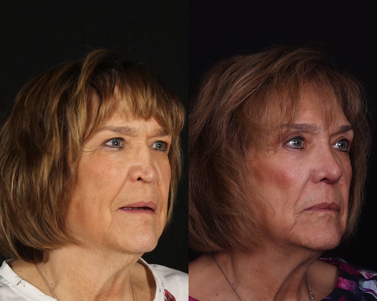 Rhinoplasty Revision Before & After Gallery - Patient 191320 - Image 2