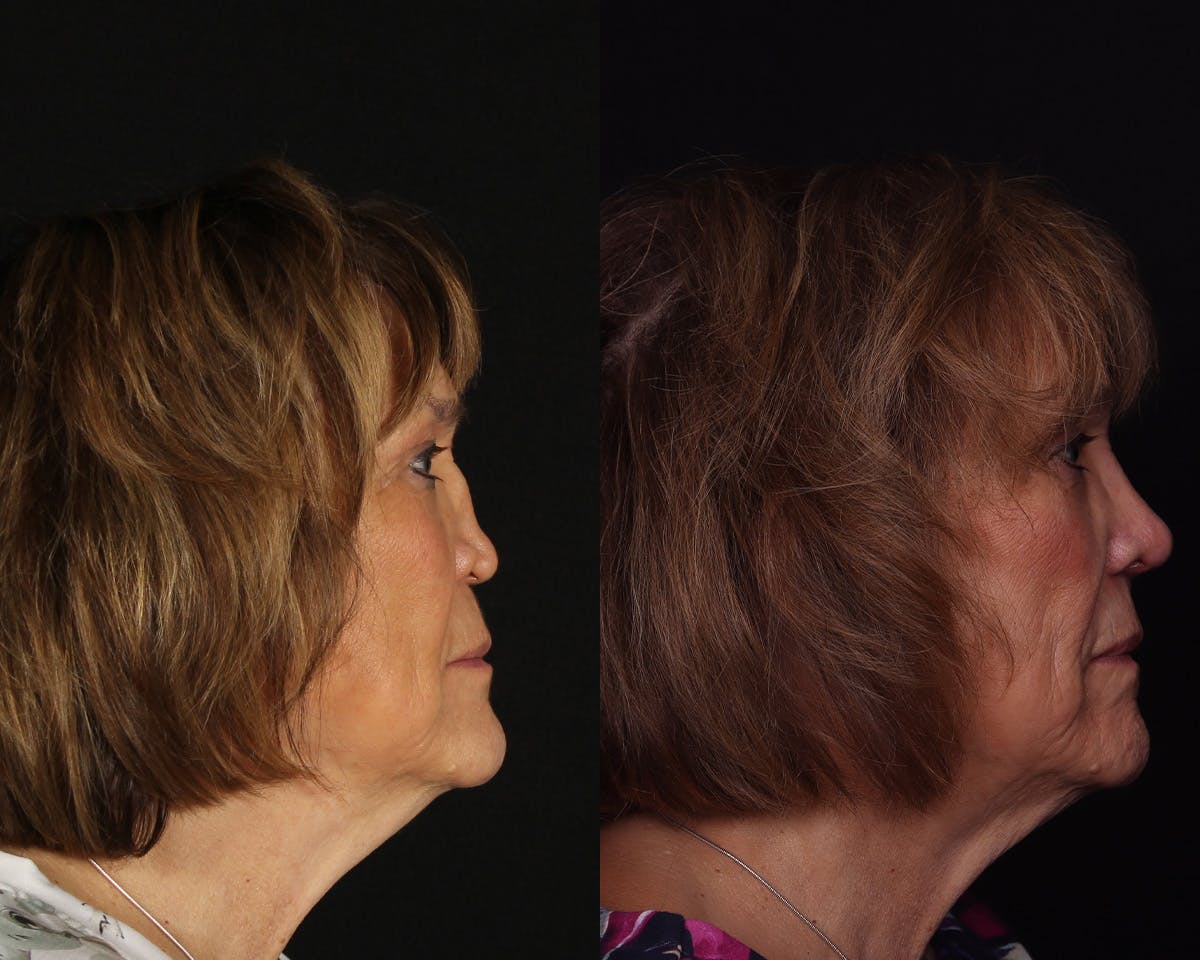 Rhinoplasty Revision Before & After Gallery - Patient 191320 - Image 1