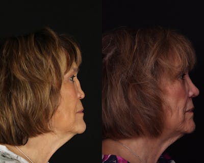 Rhinoplasty Revision Before & After Gallery - Patient 191320 - Image 1