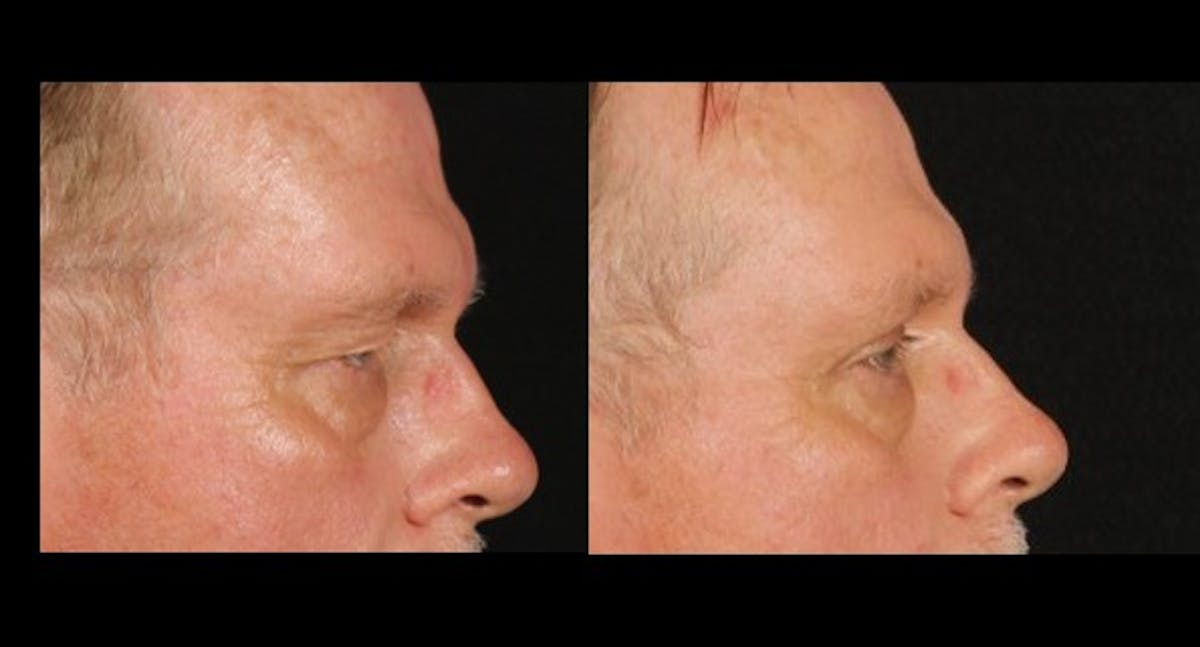 Blepharoplasty Before & After Gallery - Patient 229273 - Image 2