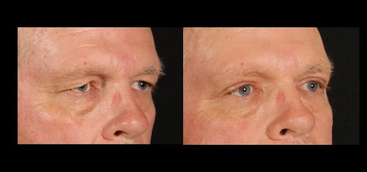 Blepharoplasty Before & After Gallery - Patient 229273 - Image 1