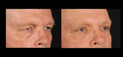 Blepharoplasty Before & After Gallery - Patient 229273 - Image 1