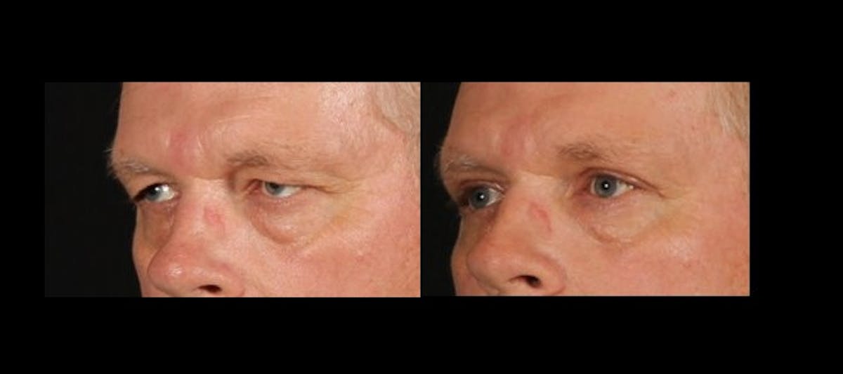 Blepharoplasty Before & After Gallery - Patient 229273 - Image 4