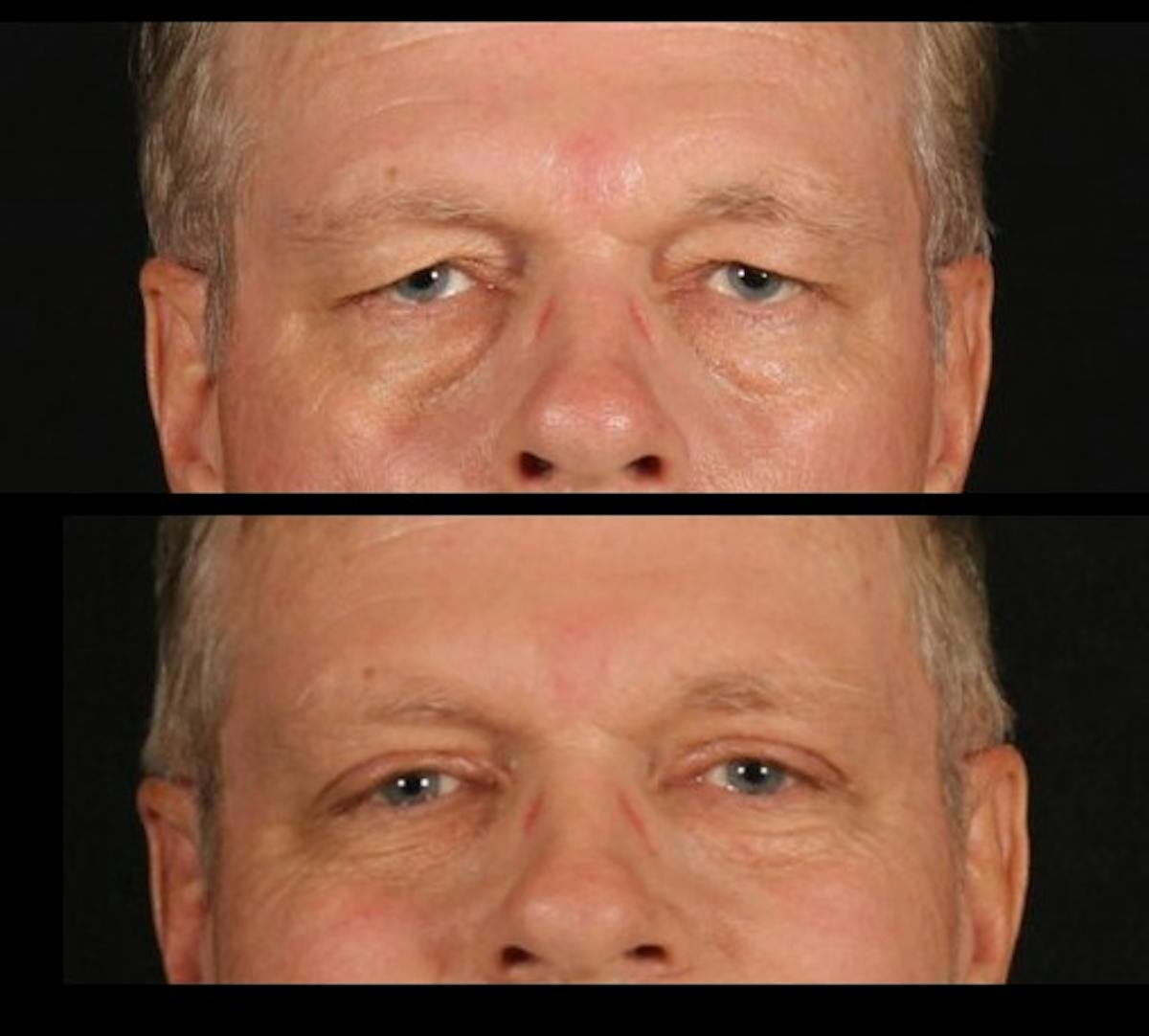 Blepharoplasty Before & After Gallery - Patient 229273 - Image 3