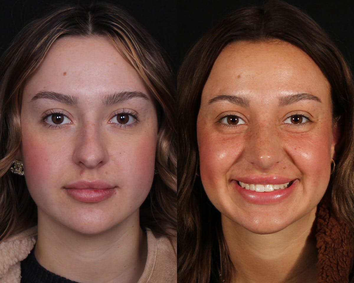 Rhinoplasty Female Before & After Gallery - Patient 342733 - Image 3