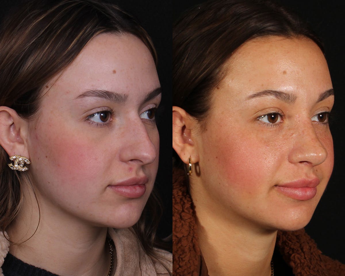 Rhinoplasty Female Before & After Gallery - Patient 342733 - Image 2