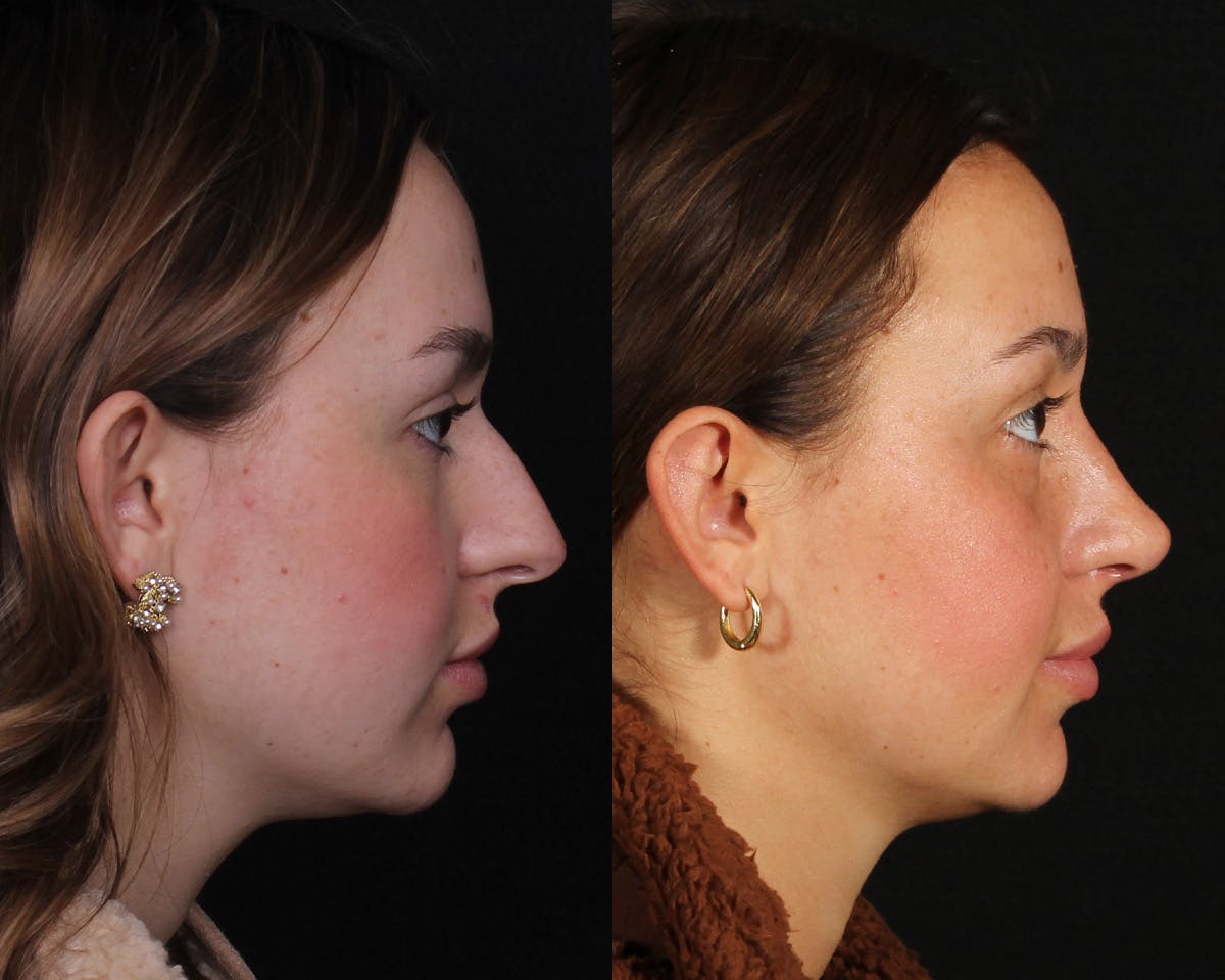 Rhinoplasty Female Before & After Gallery - Patient 342733 - Image 1