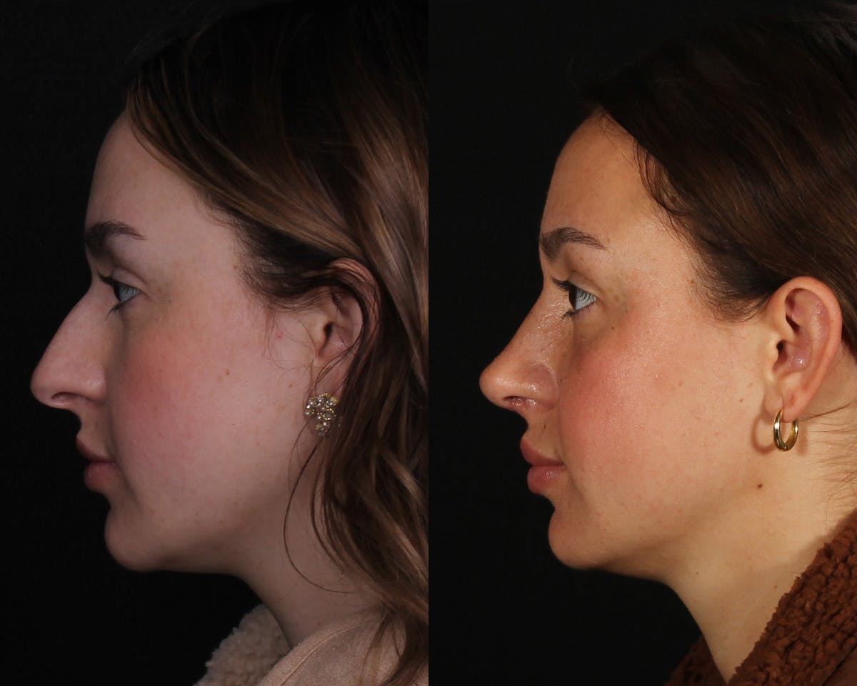 Rhinoplasty Female Before & After Gallery - Patient 342733 - Image 5