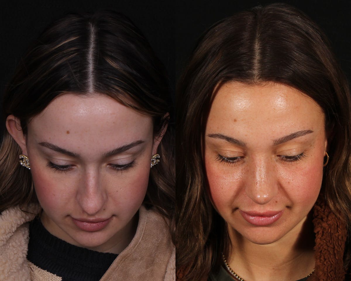 Rhinoplasty Female Before & After Gallery - Patient 342733 - Image 6