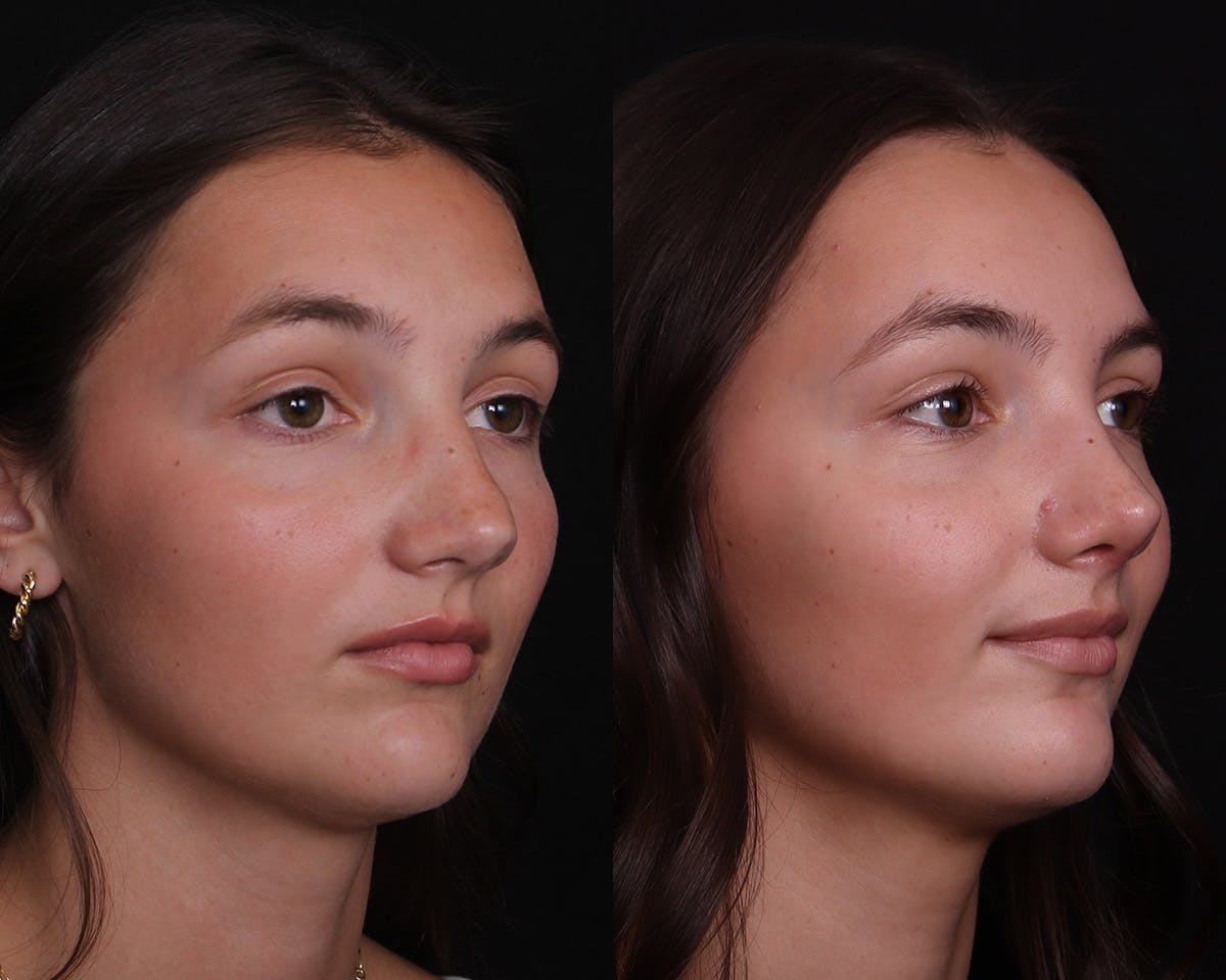 Rhinoplasty Female Before & After Gallery - Patient 148442 - Image 2