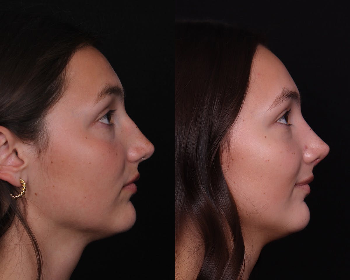 Rhinoplasty Female Before & After Gallery - Patient 148442 - Image 1
