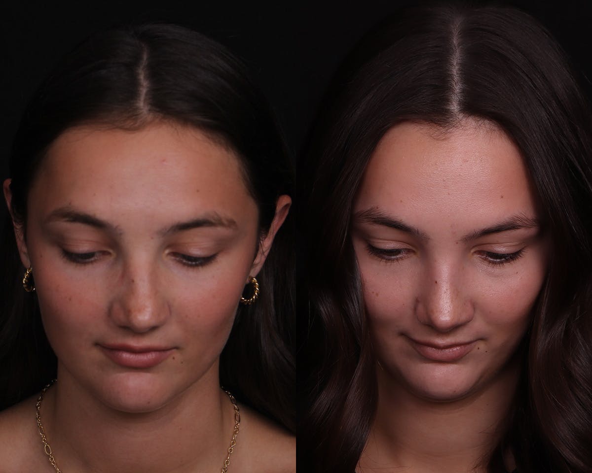 Rhinoplasty Female Before & After Gallery - Patient 148442 - Image 5