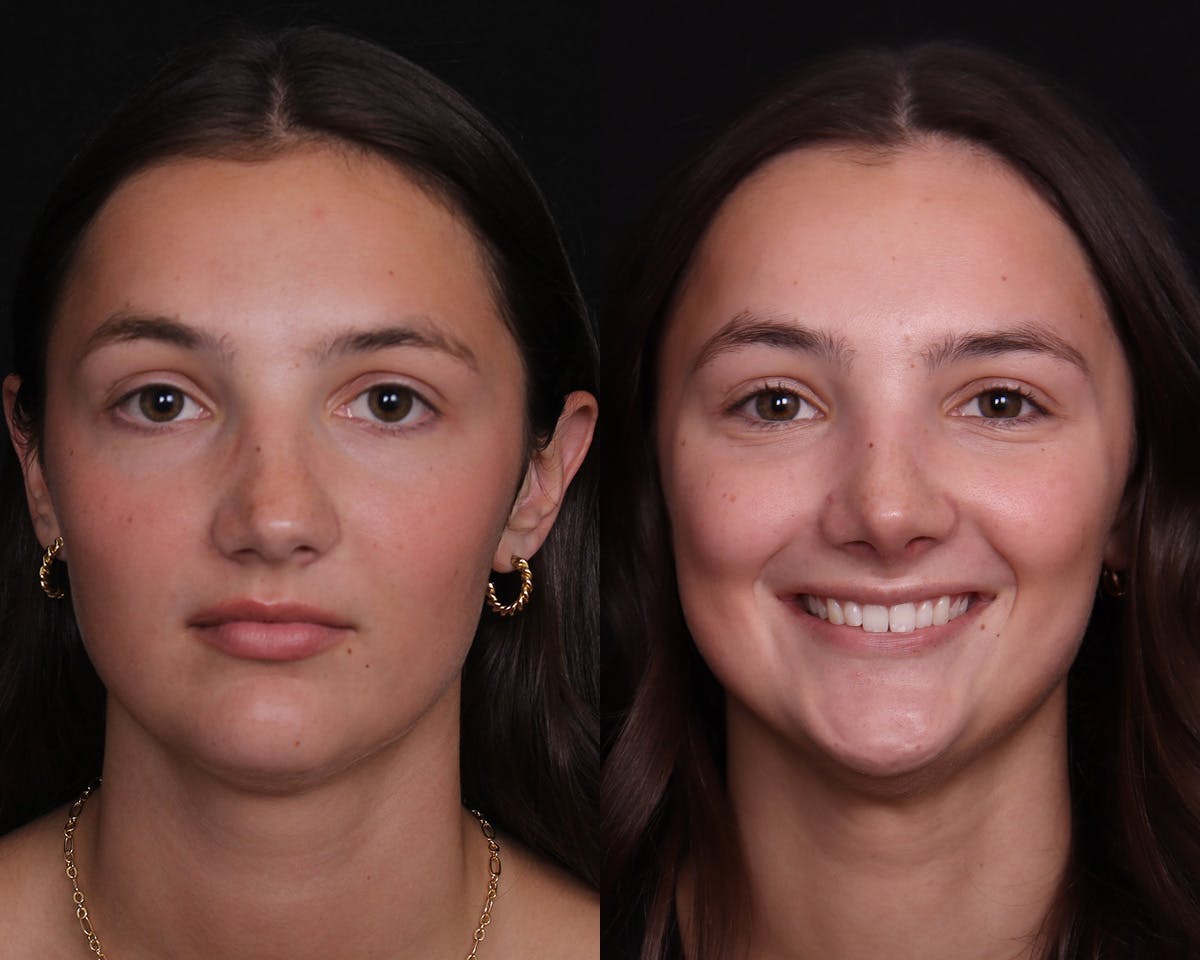 Rhinoplasty Female Before & After Gallery - Patient 148442 - Image 3