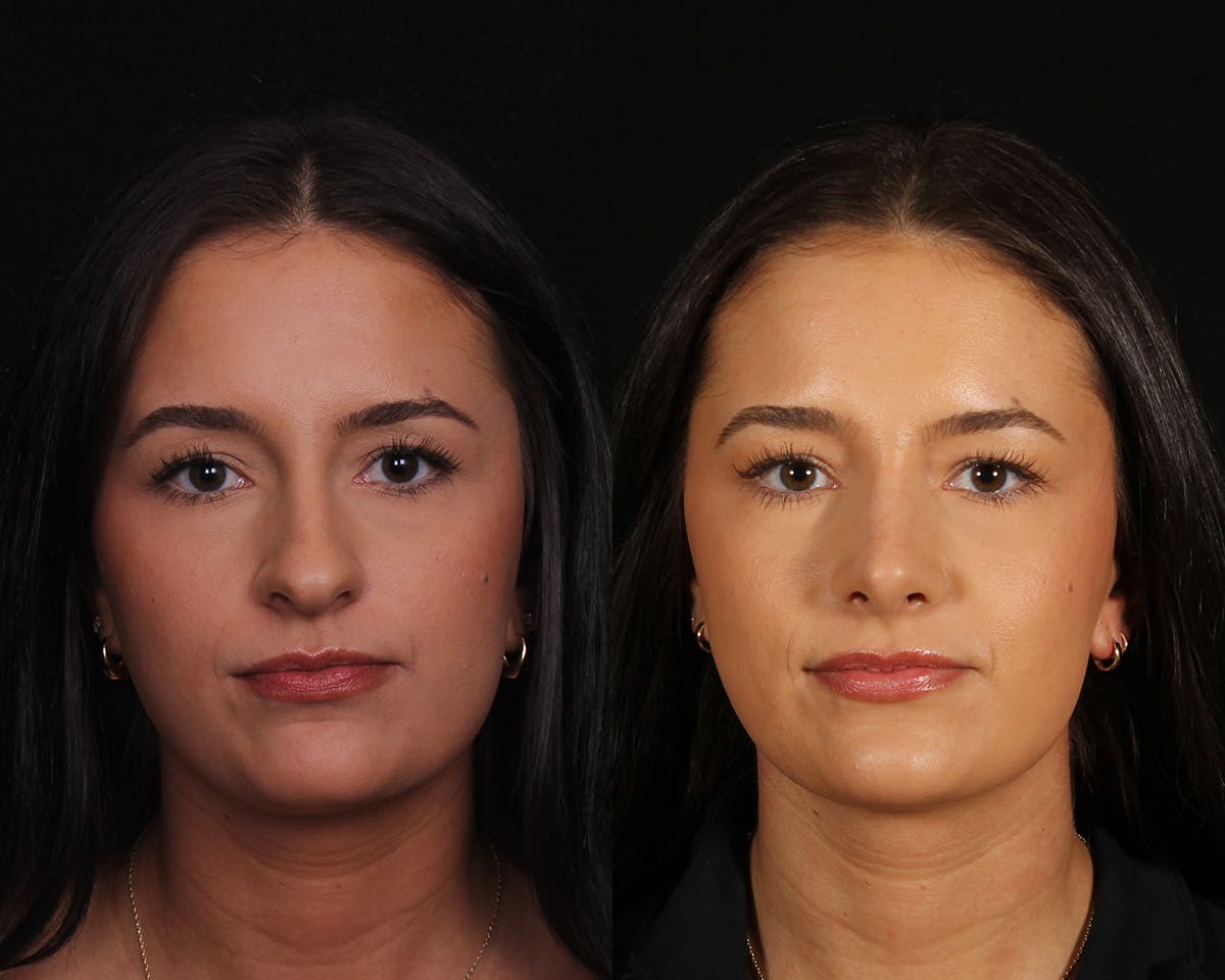 Rhinoplasty Female Before & After Gallery - Patient 374522 - Image 3