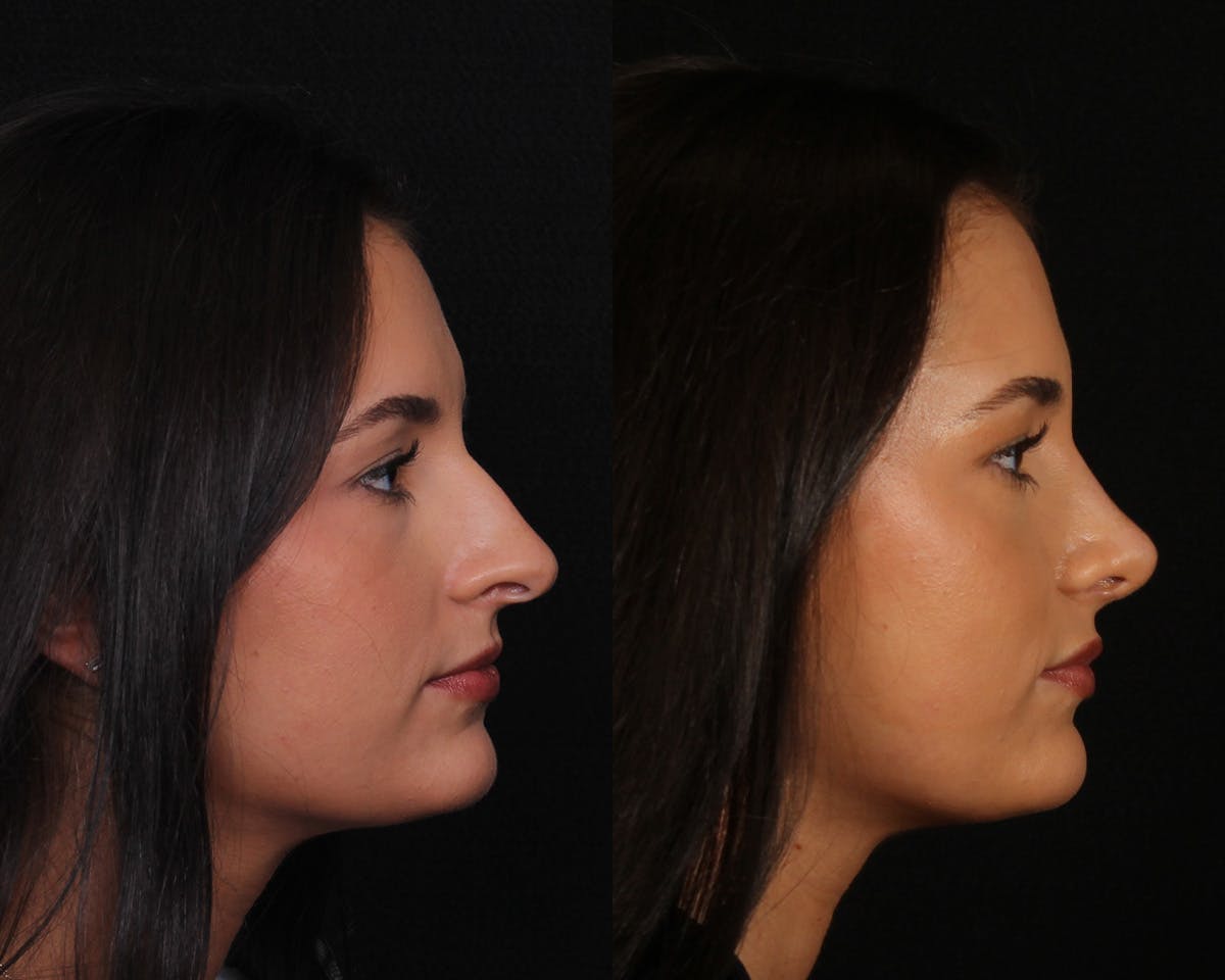 Rhinoplasty Female Before & After Gallery - Patient 374522 - Image 1