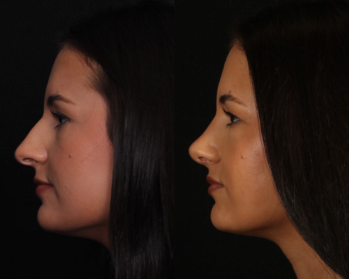 Rhinoplasty Female Before & After Gallery - Patient 374522 - Image 5