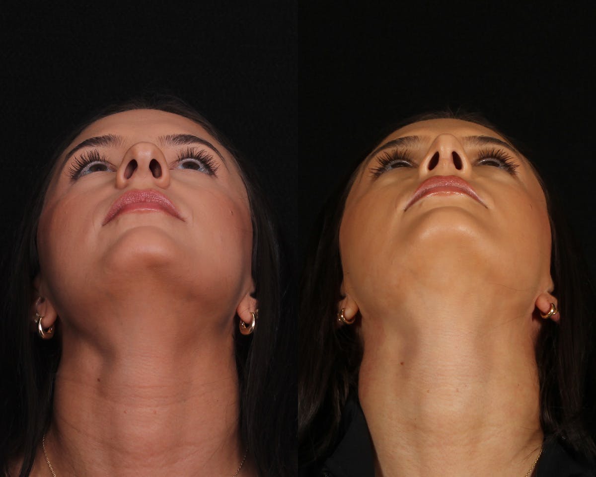 Rhinoplasty Female Before & After Gallery - Patient 374522 - Image 6