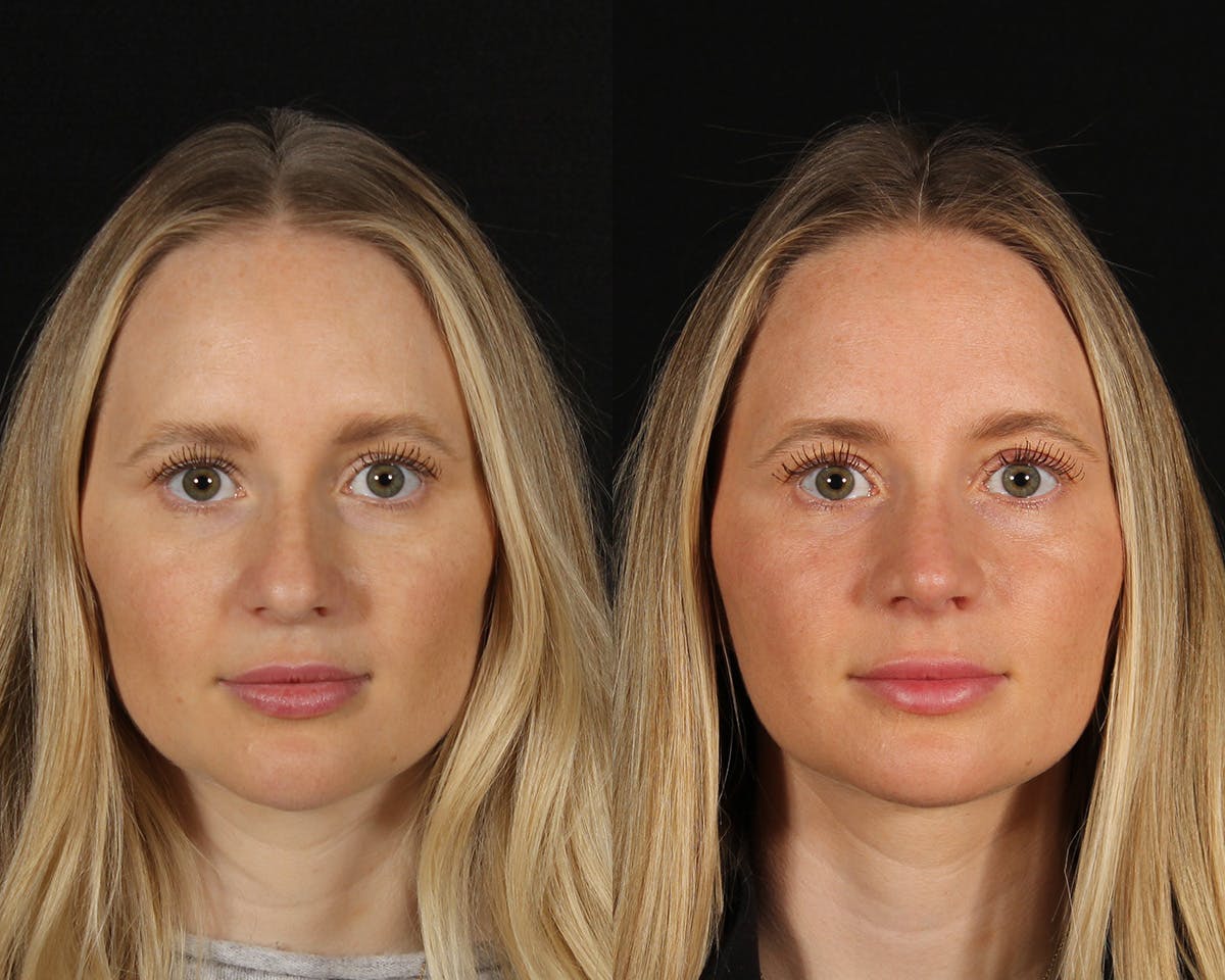 Rhinoplasty Female Before & After Gallery - Patient 451854 - Image 3