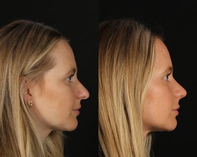 Rhinoplasty Female Before & After Gallery - Patient 451854 - Image 1