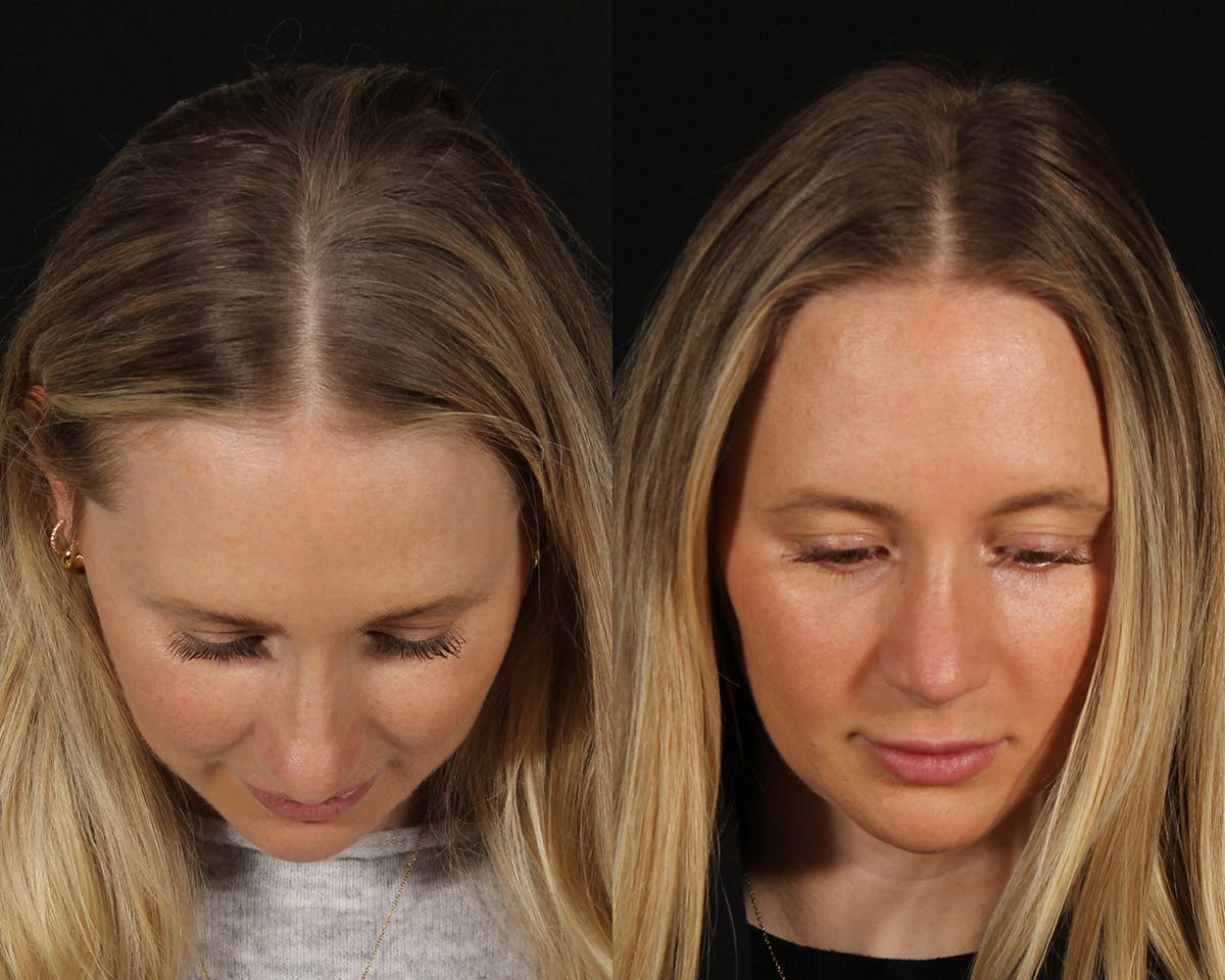 Rhinoplasty Female Before & After Gallery - Patient 451854 - Image 5