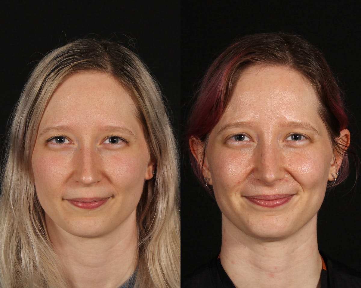 Rhinoplasty Female Before & After Gallery - Patient 285778 - Image 3