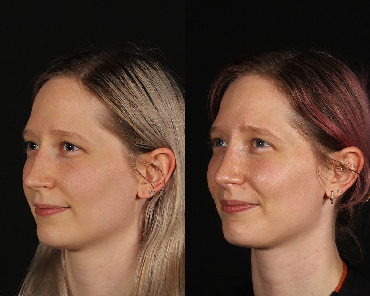 Rhinoplasty Female Before & After Gallery - Patient 285778 - Image 4