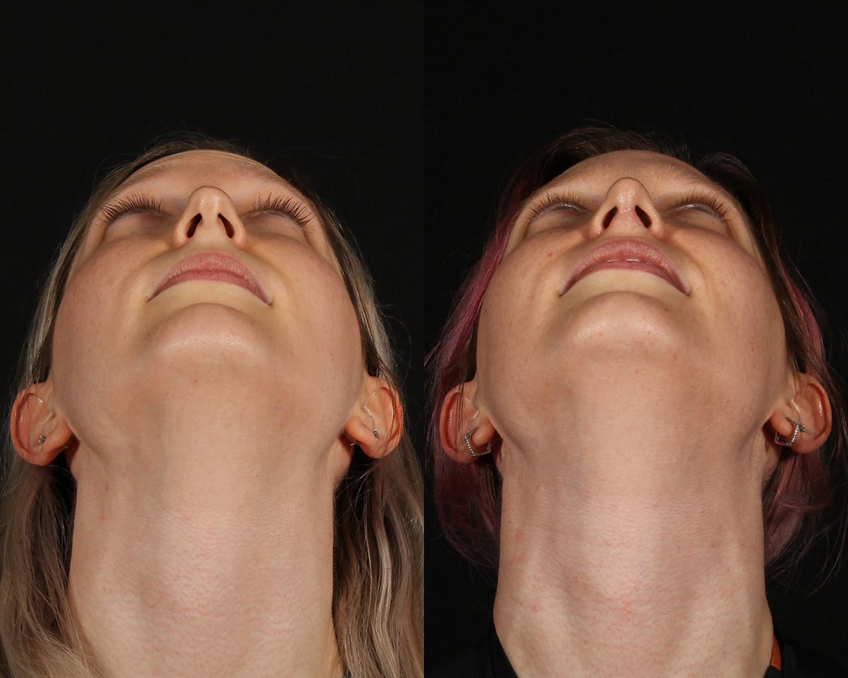 Rhinoplasty Female Before & After Gallery - Patient 285778 - Image 6