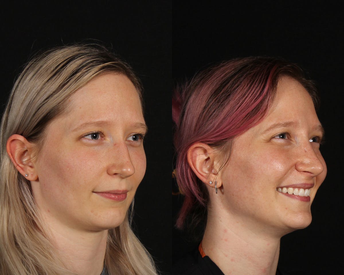 Rhinoplasty Female Before & After Gallery - Patient 285778 - Image 2