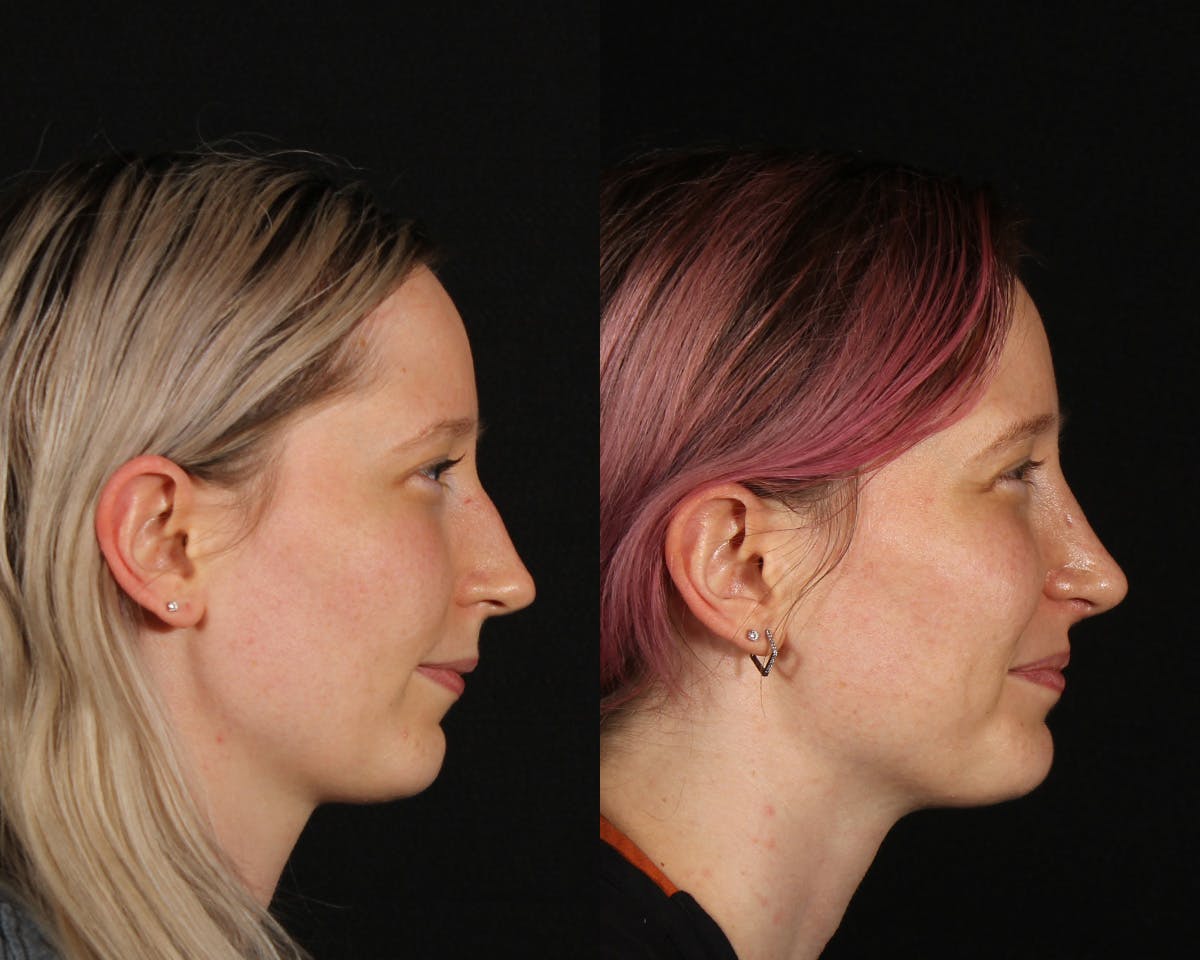 Rhinoplasty Female Before & After Gallery - Patient 285778 - Image 1