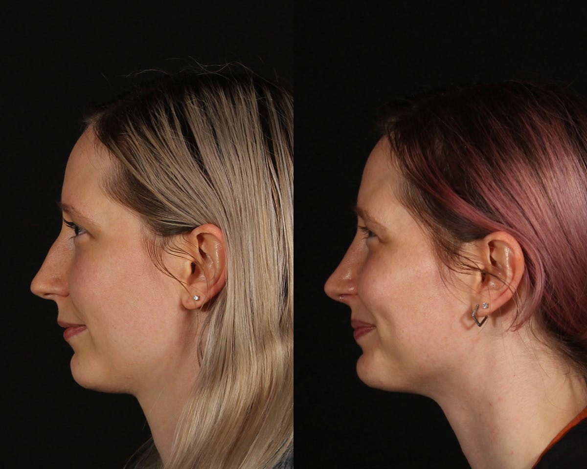 Rhinoplasty Female Before & After Gallery - Patient 285778 - Image 5
