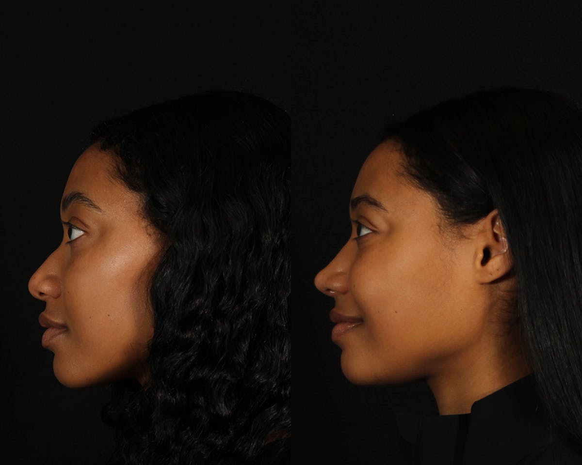 Rhinoplasty Female Before & After Gallery - Patient 168807 - Image 4