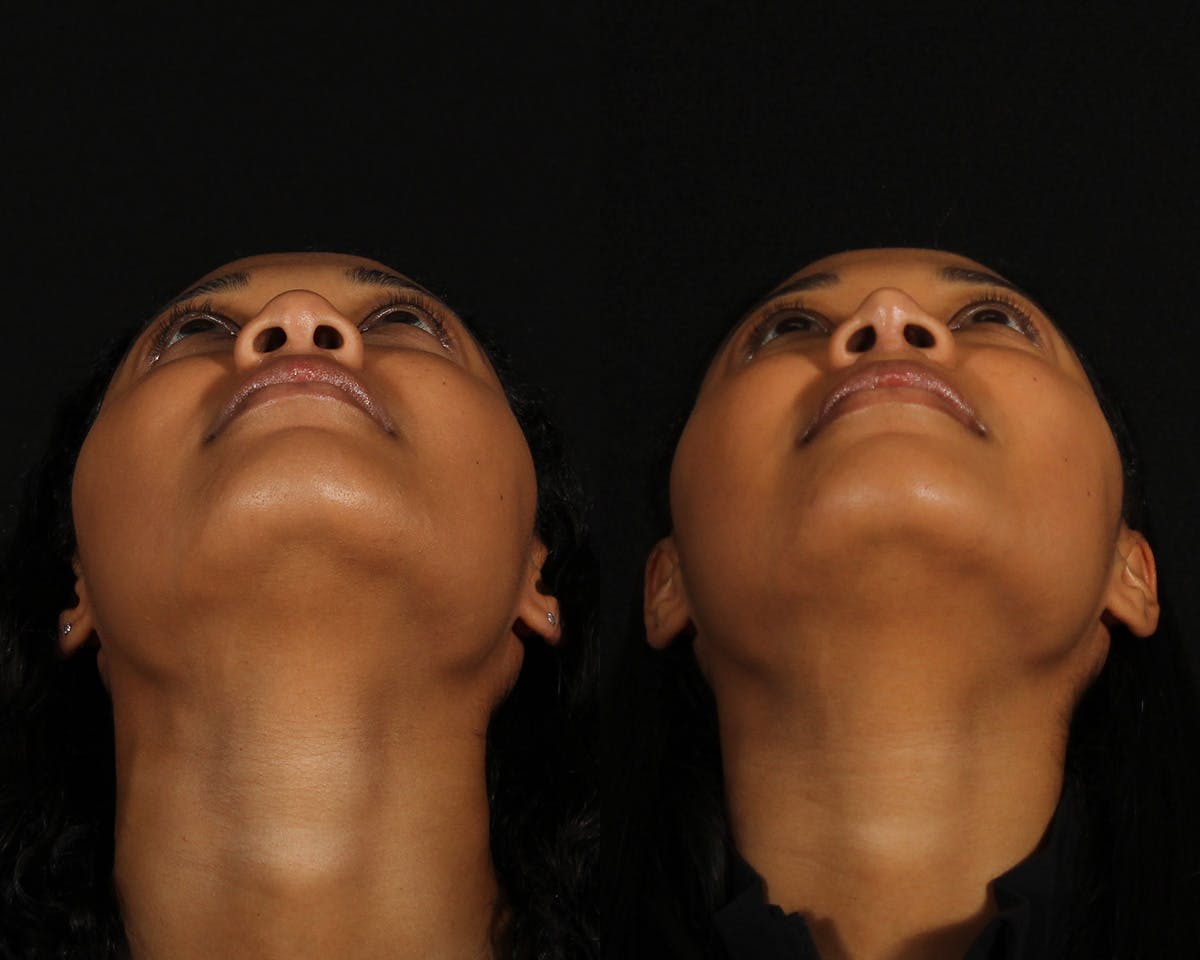 Rhinoplasty Female Before & After Gallery - Patient 168807 - Image 6