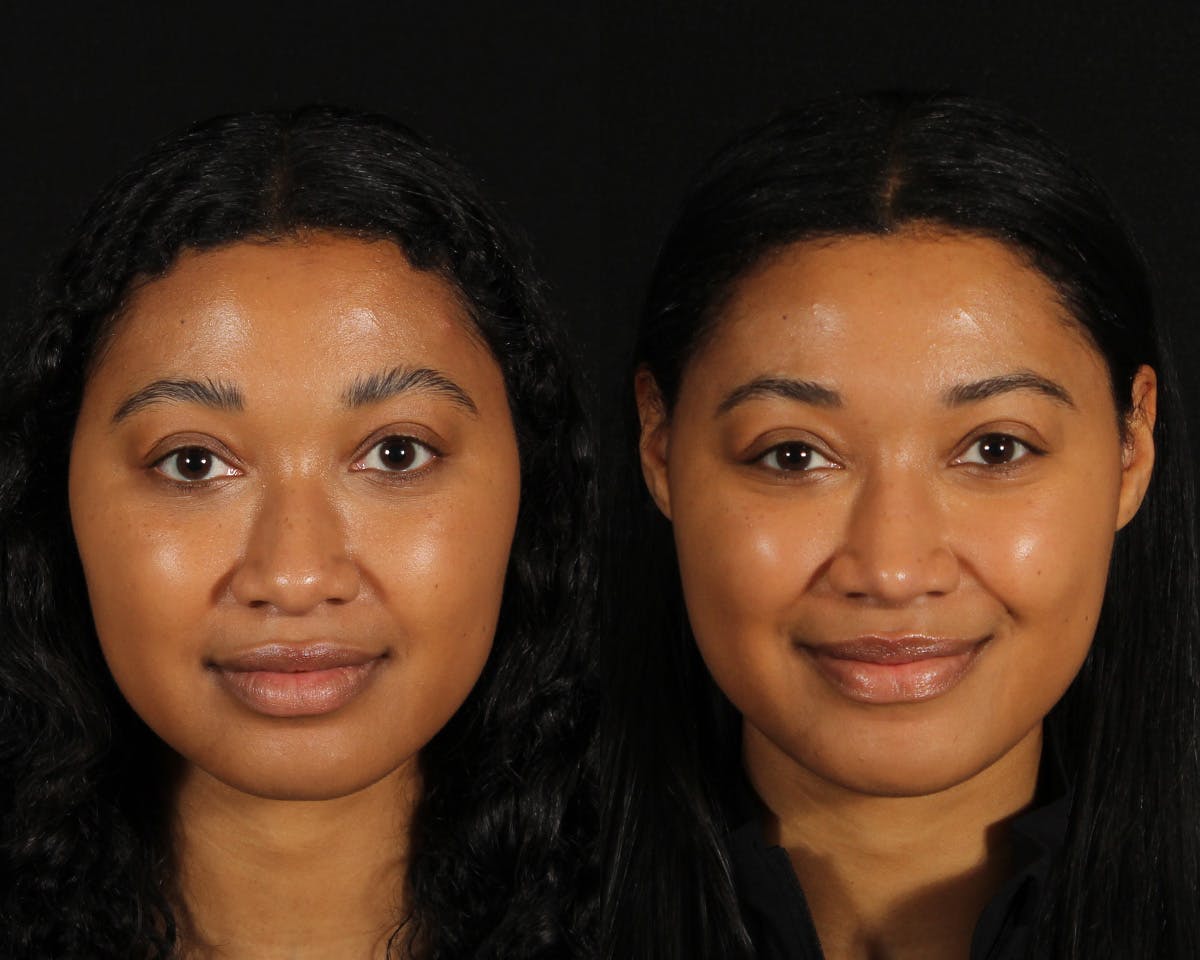 Rhinoplasty Female Before & After Gallery - Patient 168807 - Image 3