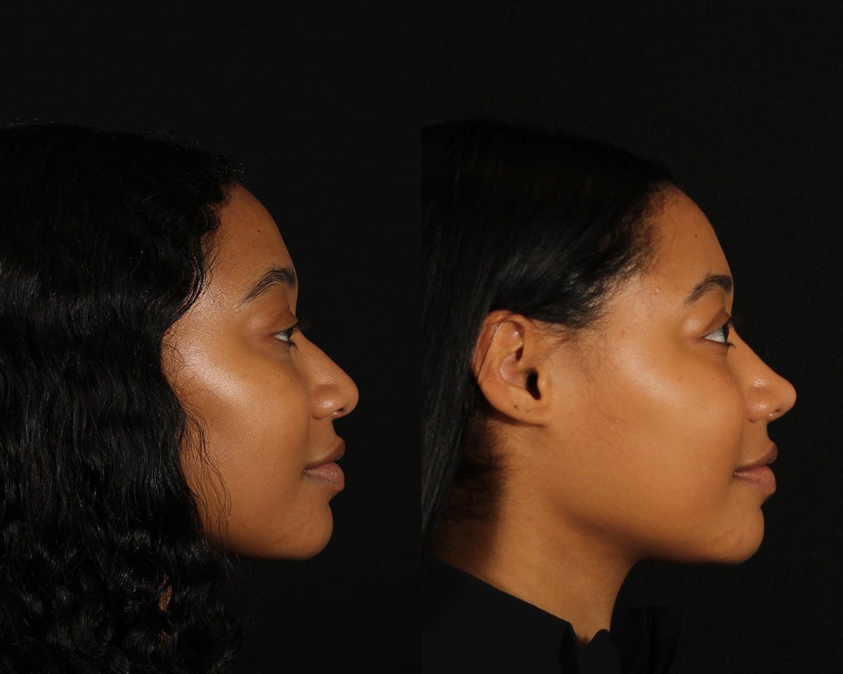 Rhinoplasty Female Before & After Gallery - Patient 168807 - Image 1