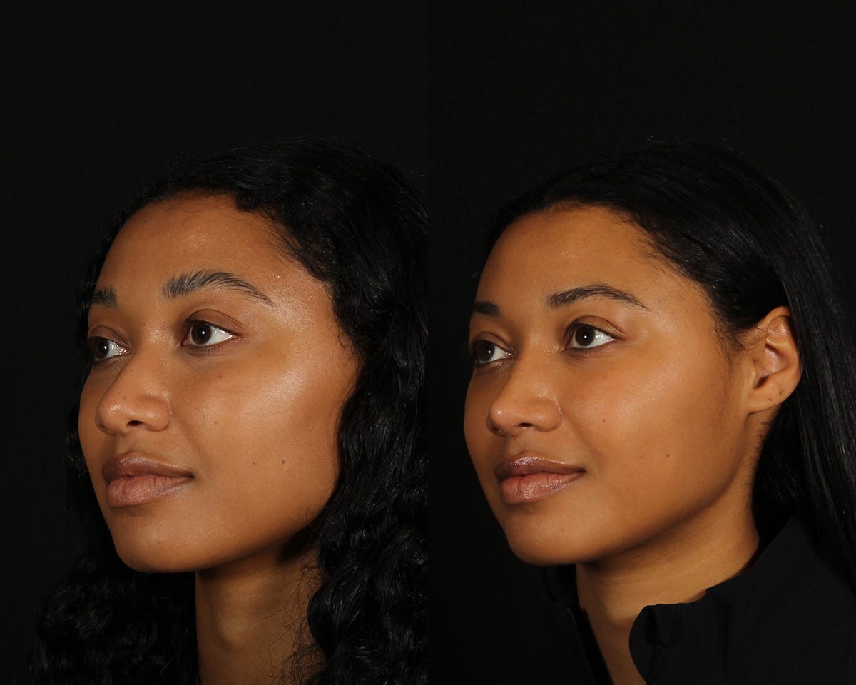 Rhinoplasty Female Before & After Gallery - Patient 168807 - Image 5