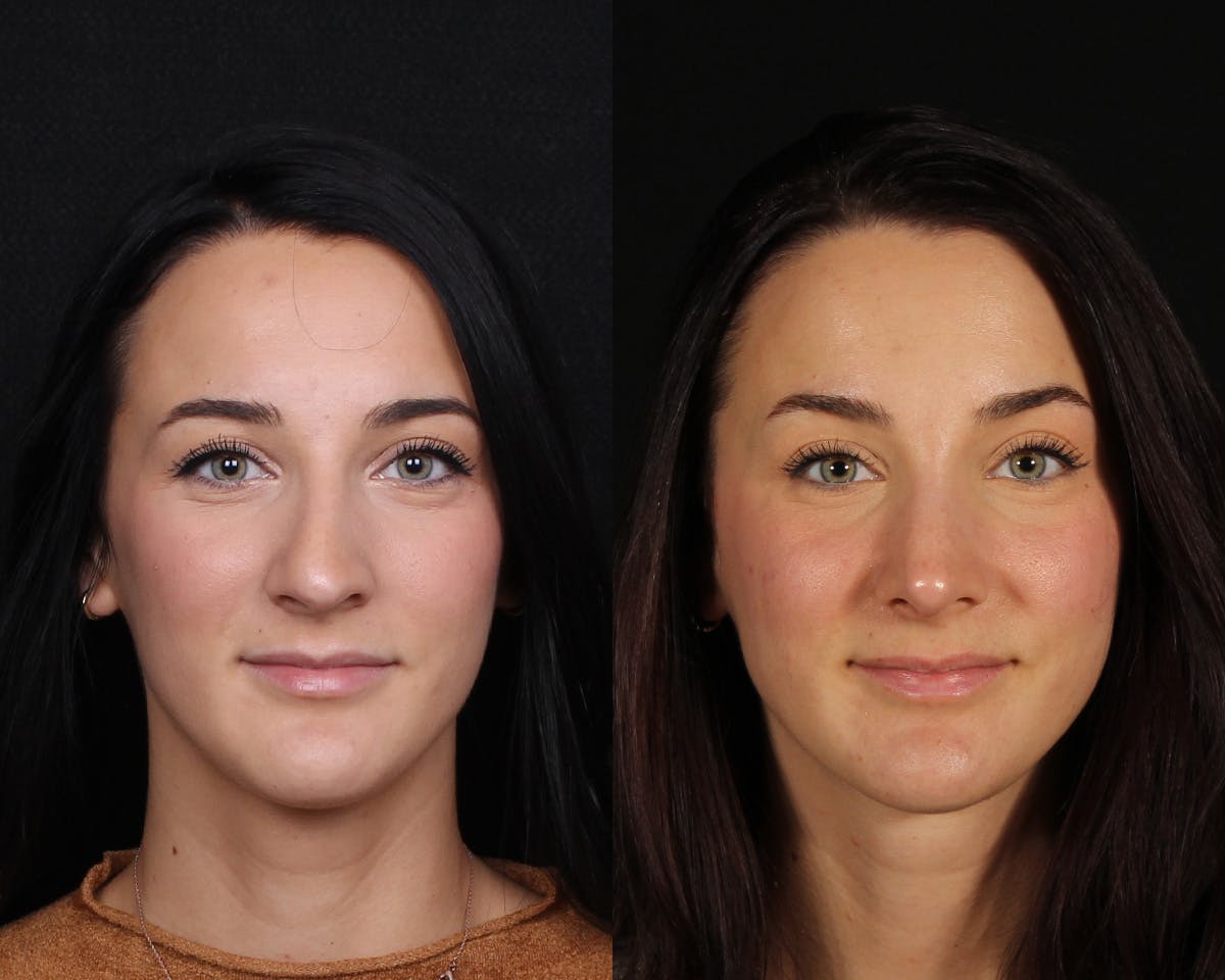 Rhinoplasty Female Before & After Gallery - Patient 369413 - Image 3