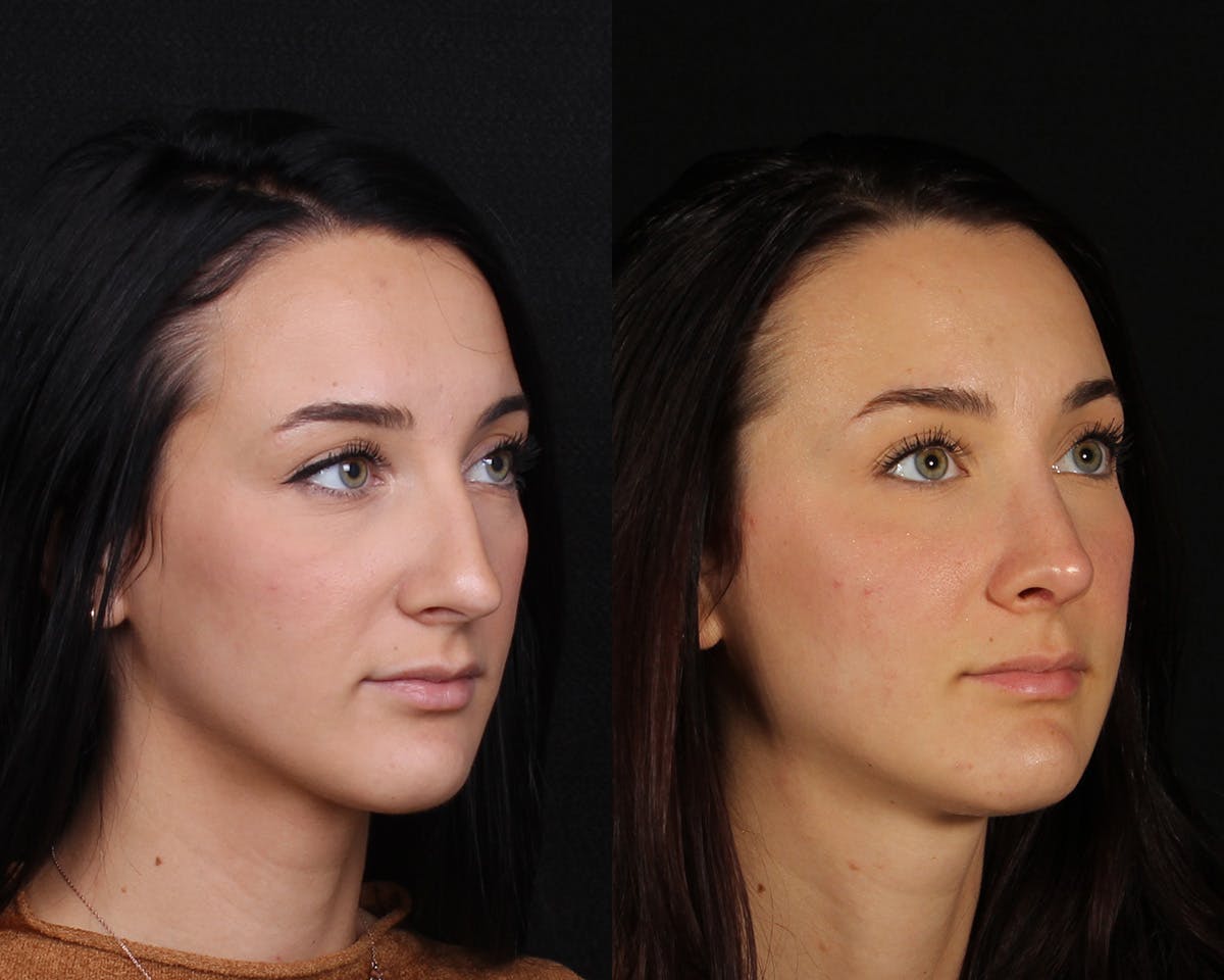 Rhinoplasty Female Before & After Gallery - Patient 369413 - Image 2