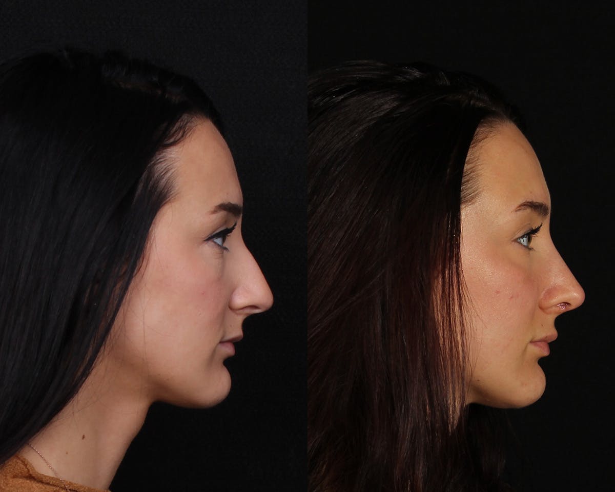 Rhinoplasty Female Before & After Gallery - Patient 369413 - Image 1