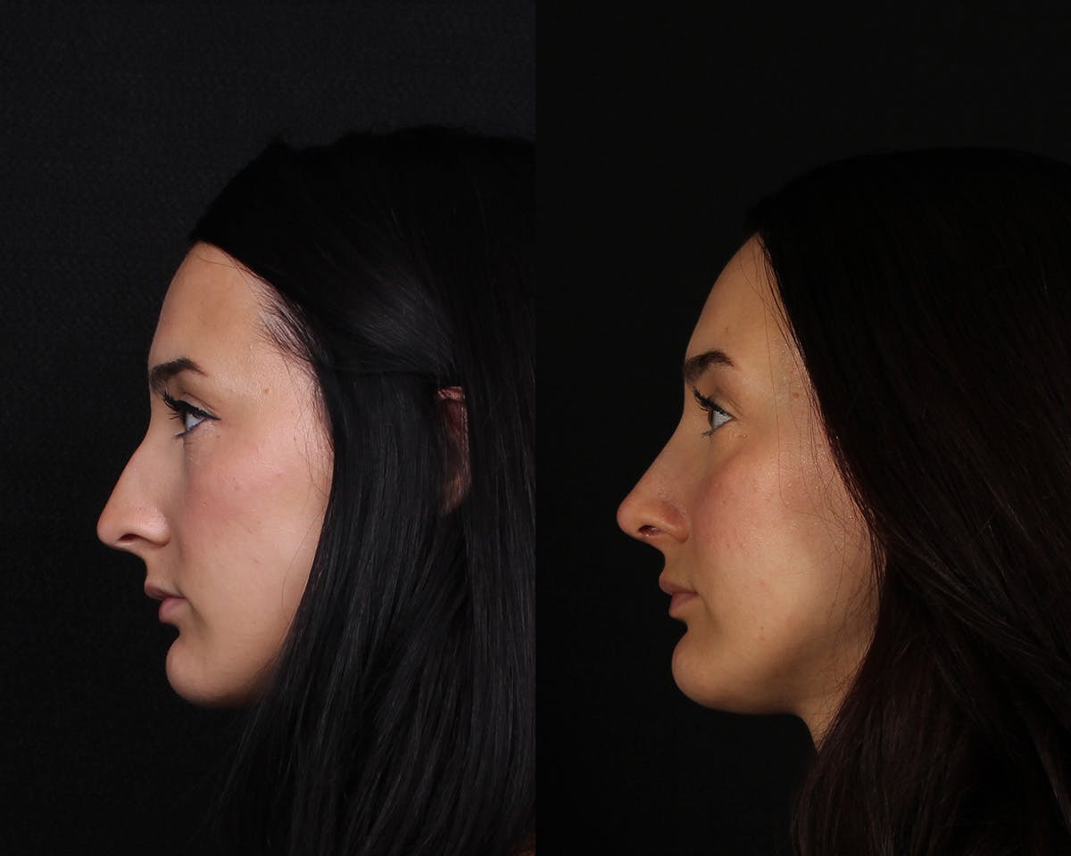 Rhinoplasty Female Before & After Gallery - Patient 369413 - Image 5