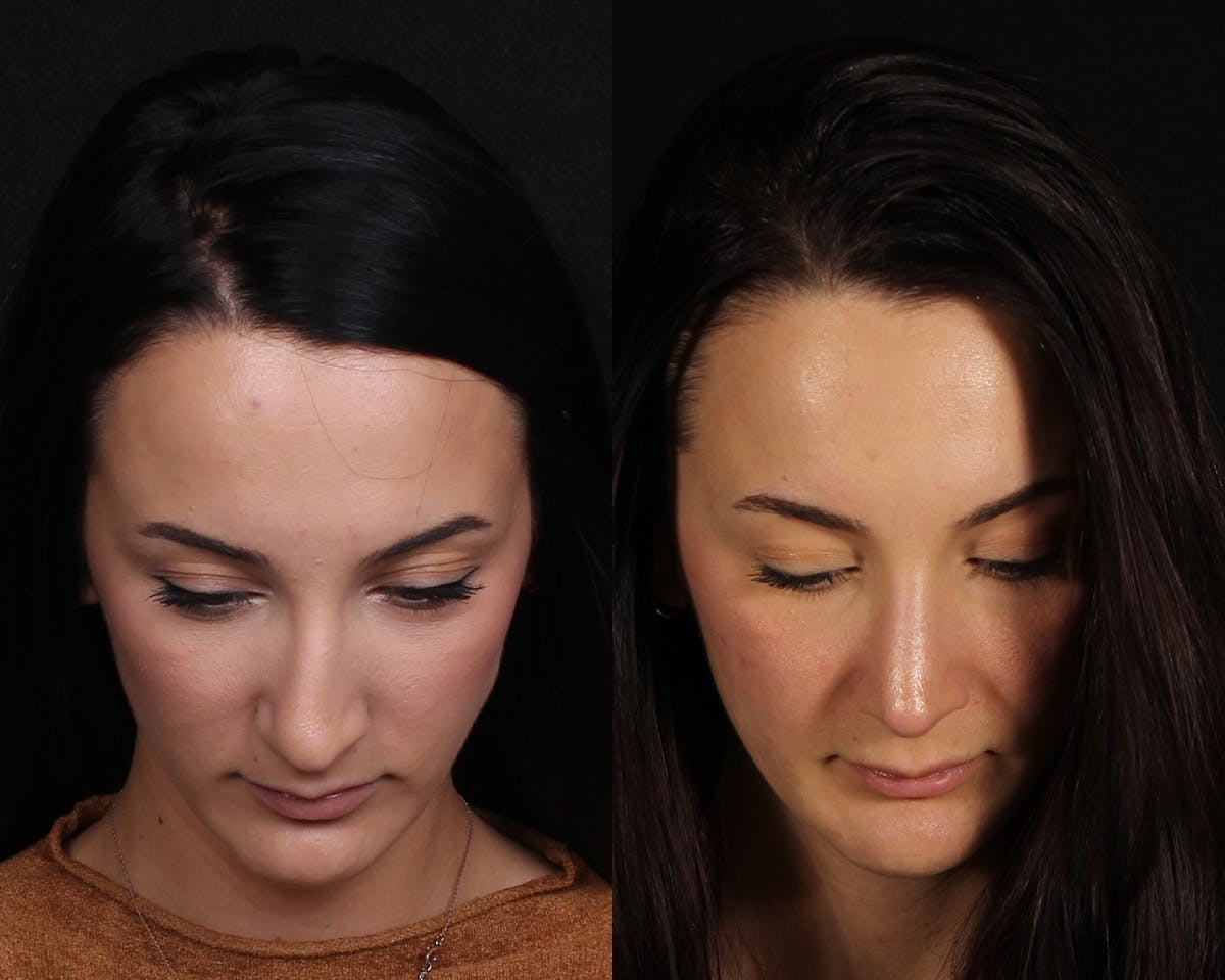Rhinoplasty Female Before & After Gallery - Patient 369413 - Image 7