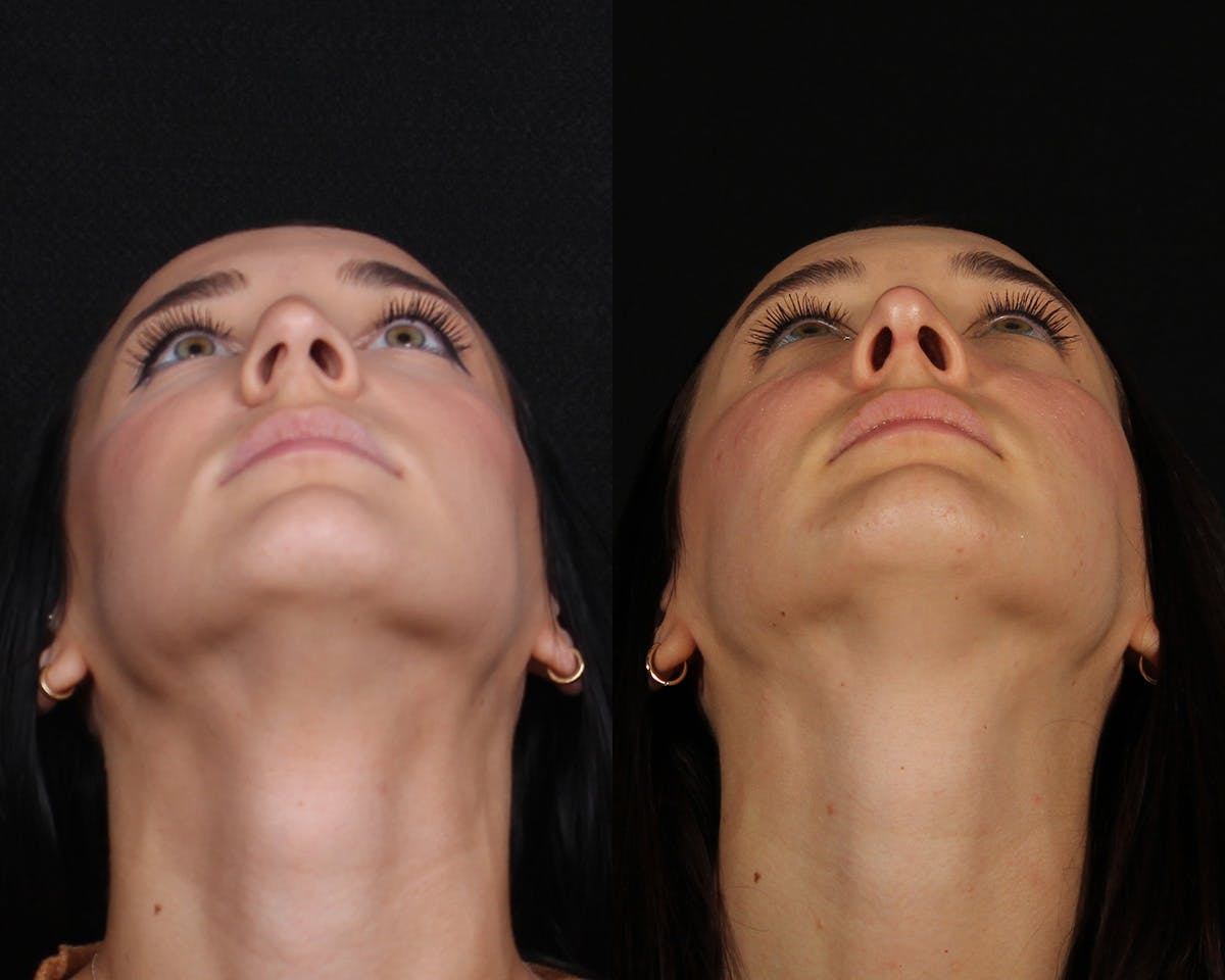 Rhinoplasty Female Before & After Gallery - Patient 369413 - Image 6
