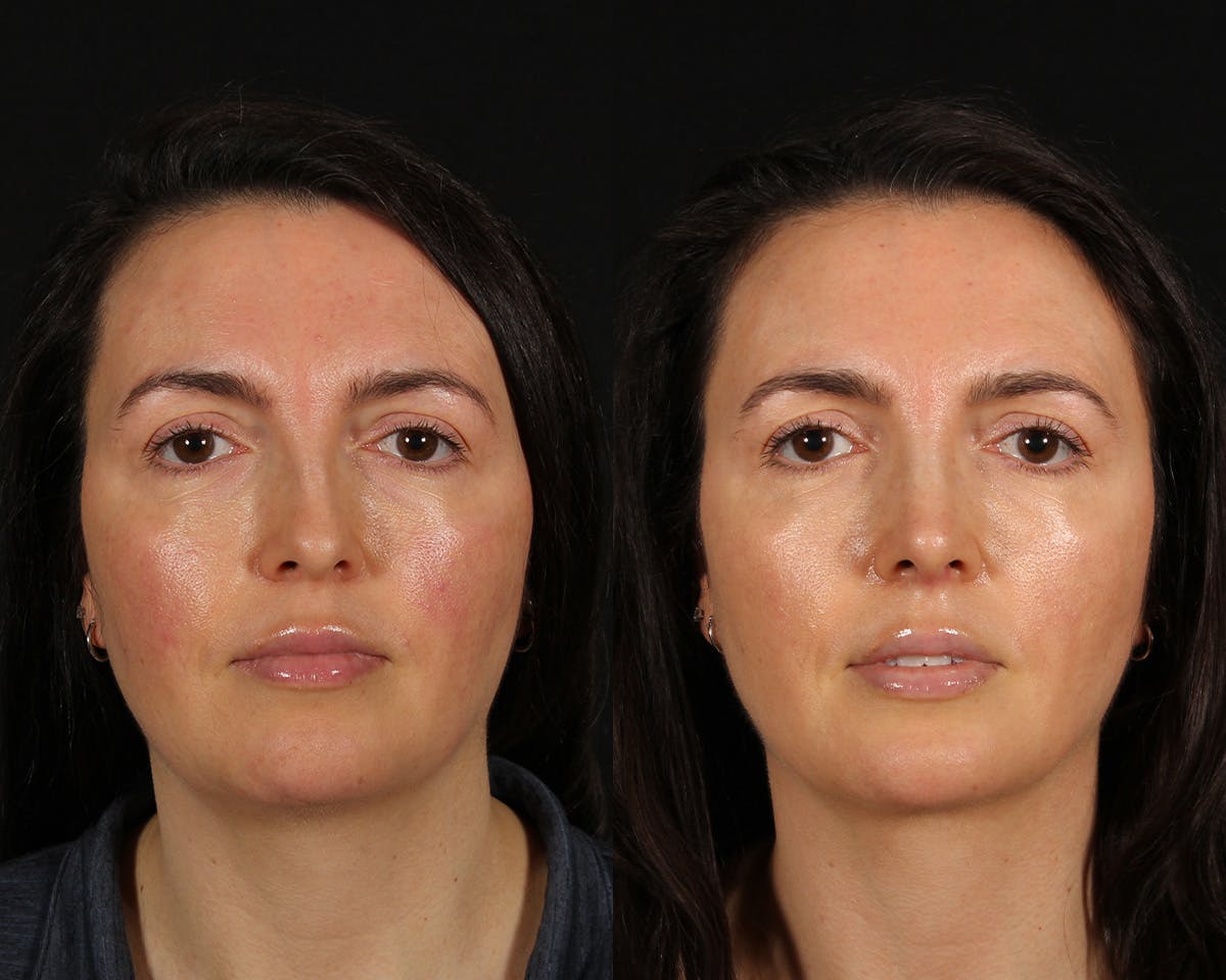 Rhinoplasty Female Before & After Gallery - Patient 361457 - Image 3