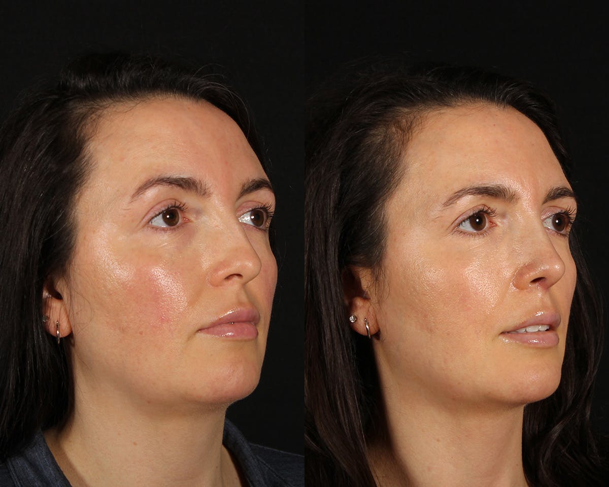 Rhinoplasty Female Before & After Gallery - Patient 361457 - Image 2