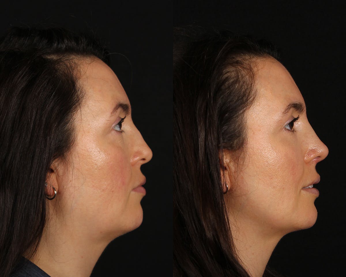 Rhinoplasty Female Before & After Gallery - Patient 361457 - Image 1