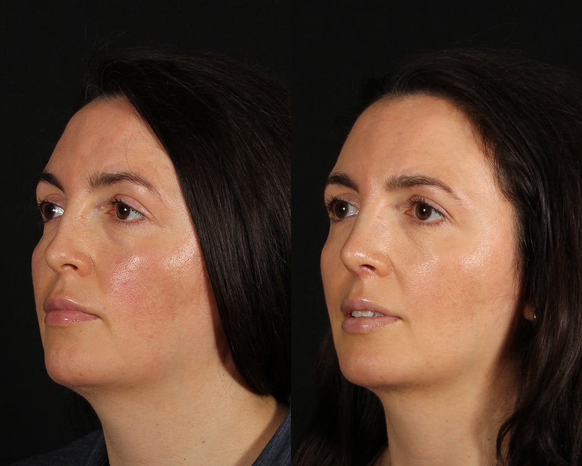 Rhinoplasty Female Before & After Gallery - Patient 361457 - Image 4