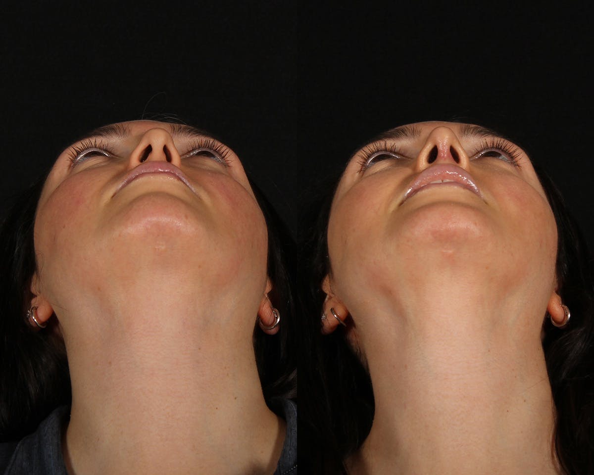Rhinoplasty Female Before & After Gallery - Patient 361457 - Image 6