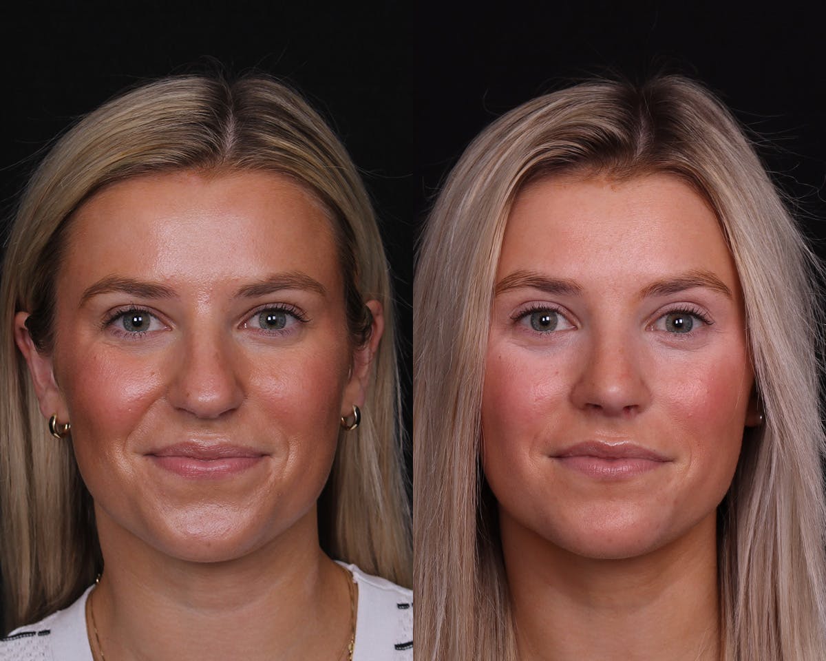 Rhinoplasty Female Before & After Gallery - Patient 421731 - Image 4