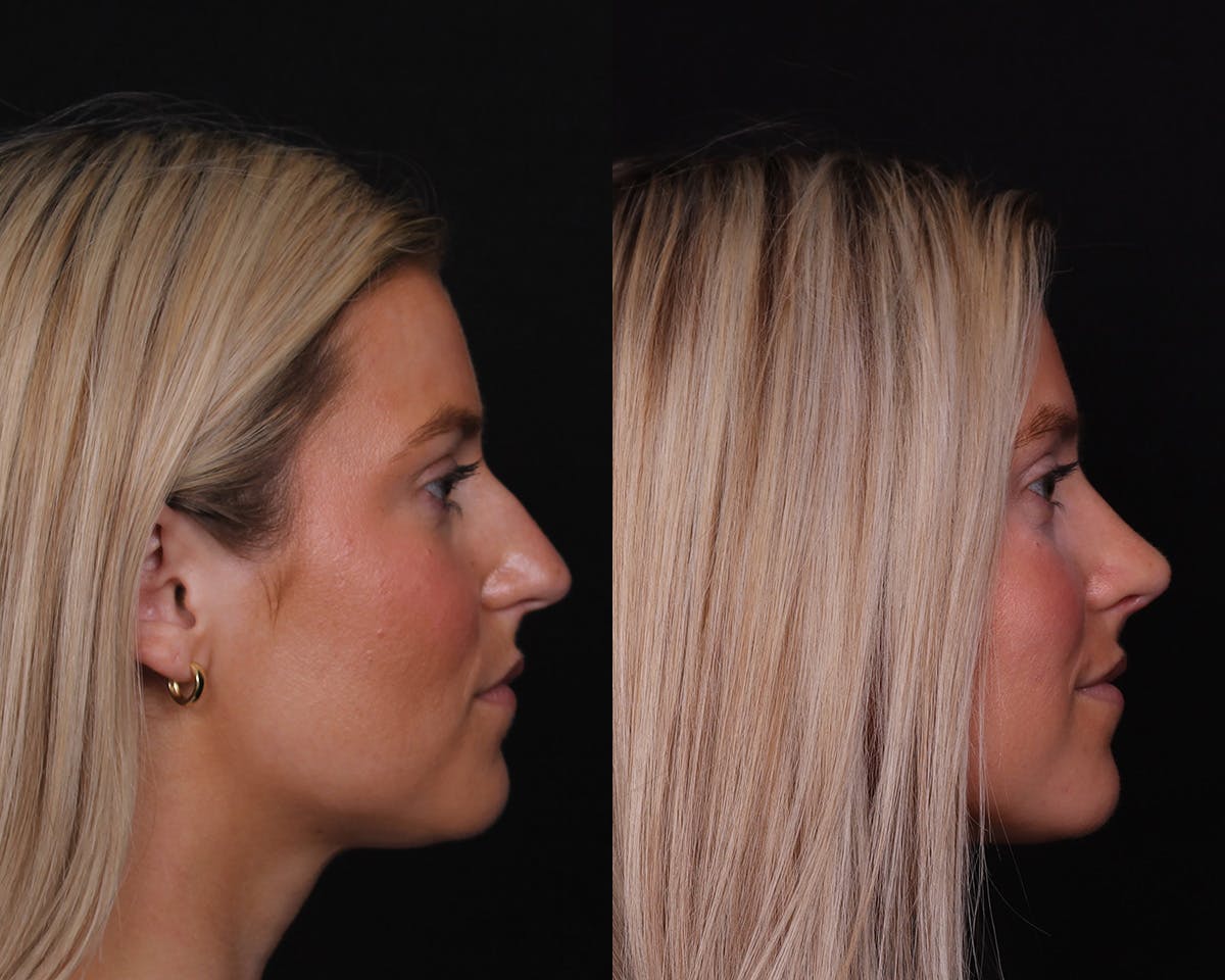 Rhinoplasty Female Before & After Gallery - Patient 421731 - Image 1