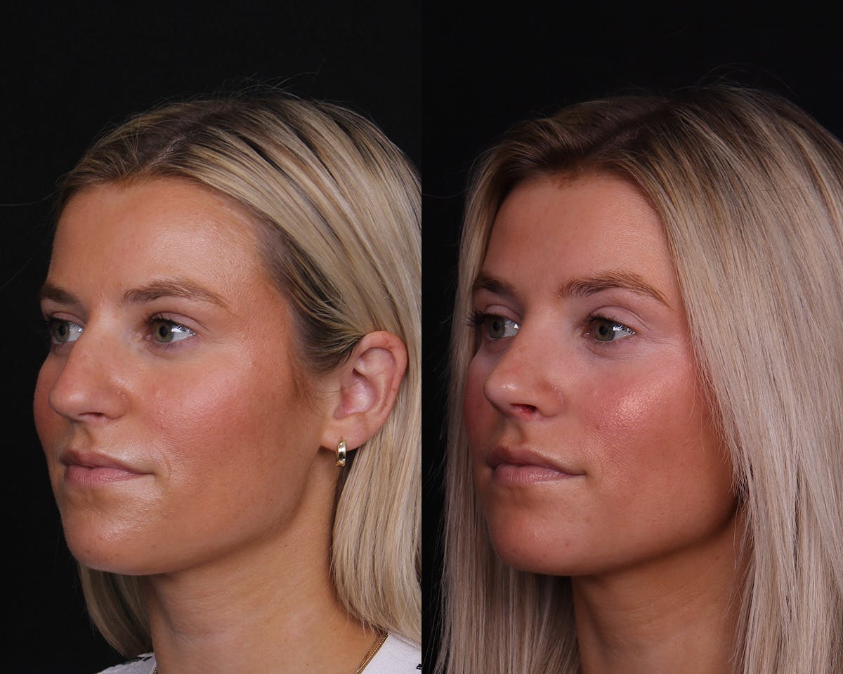 Rhinoplasty Female Before & After Gallery - Patient 421731 - Image 3